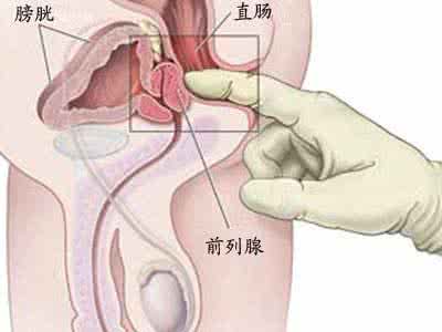 你知道前列腺炎的三大护理要点吗