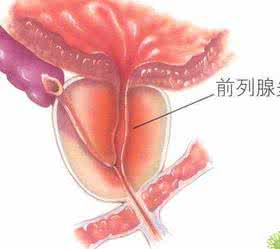 前列腺炎是怎么回事