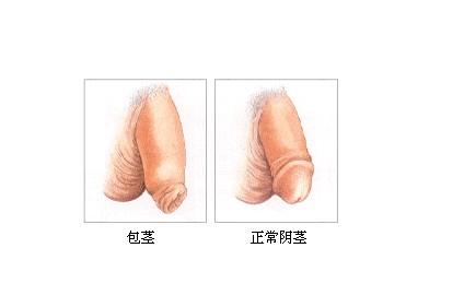 不治疗包茎会有什么影响